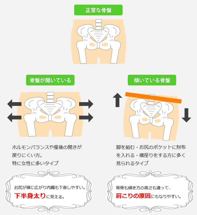 骨盤には様々なタイプがあります。開いている骨盤や傾いている骨盤です。